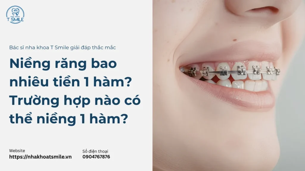 niềng răng bao nhiêu tiền 1 hàm