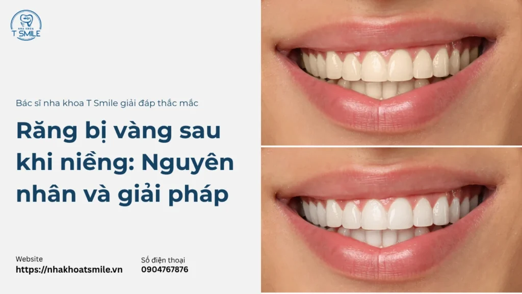 răng bị vàng sau khi niềng