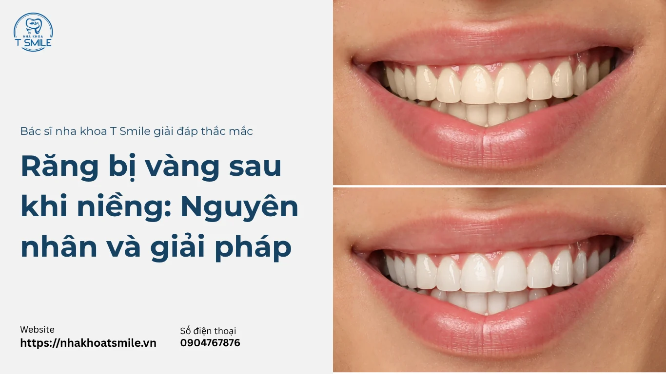 răng bị vàng sau khi niềng