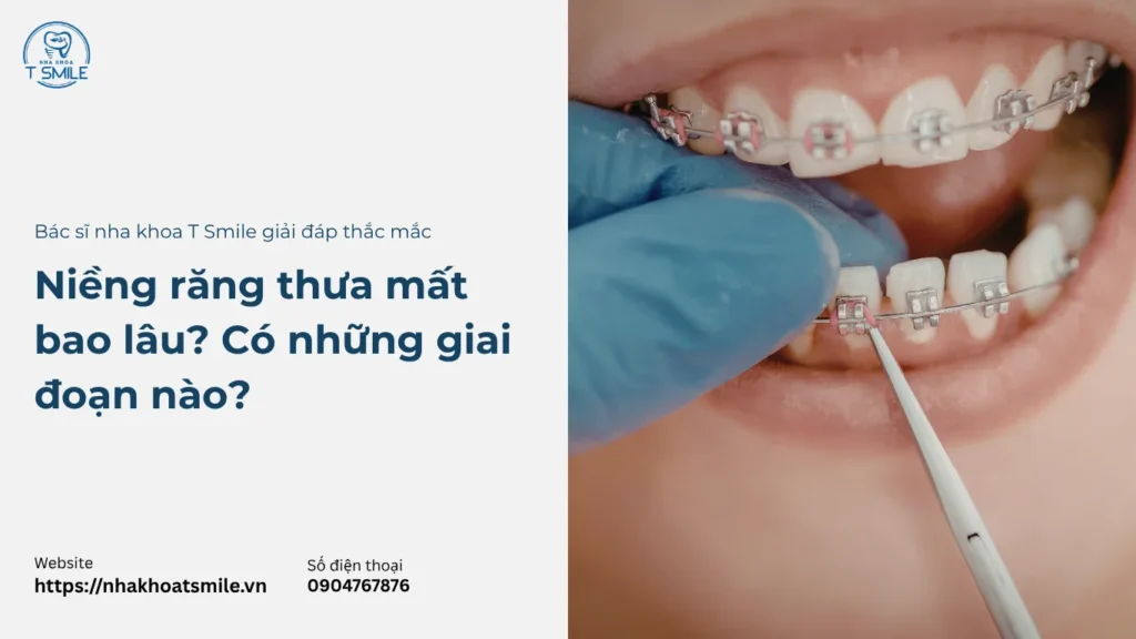 niềng răng thưa mất bao lâu