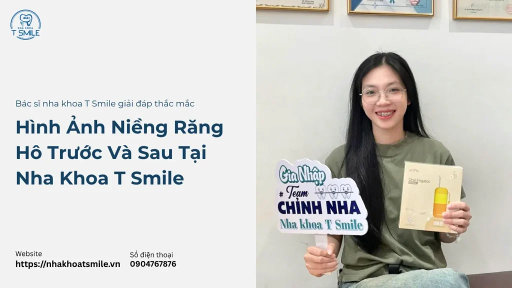 hình ảnh niềng răng hô trước và sau