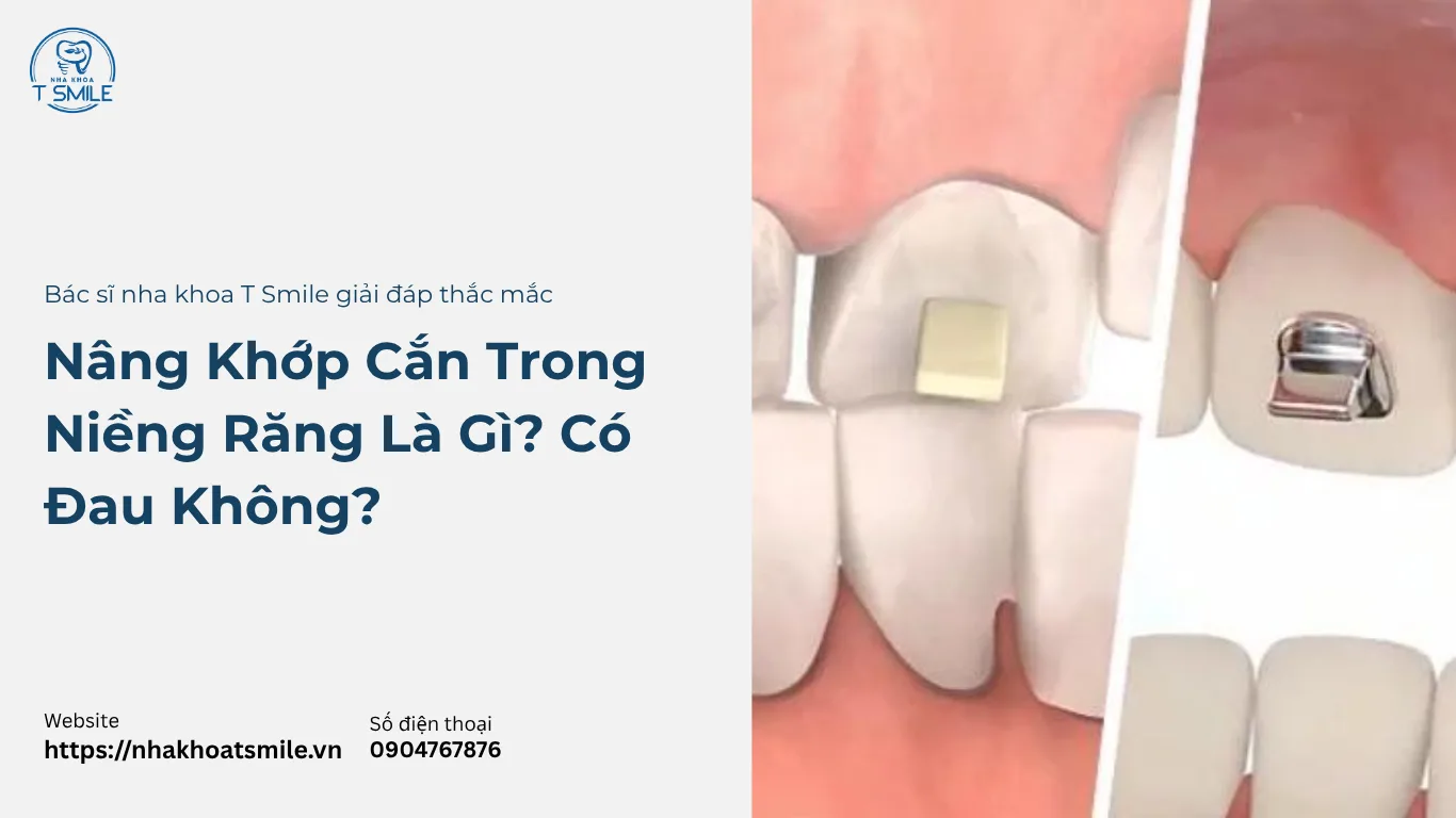 nâng khớp cắn trong niềng răng