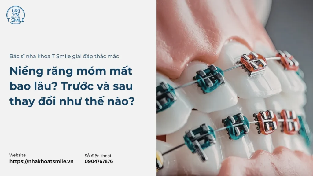 niềng răng móm mất bao lâu