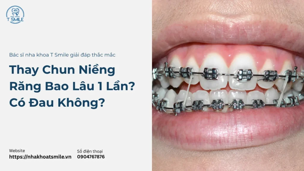 thay chun niềng răng