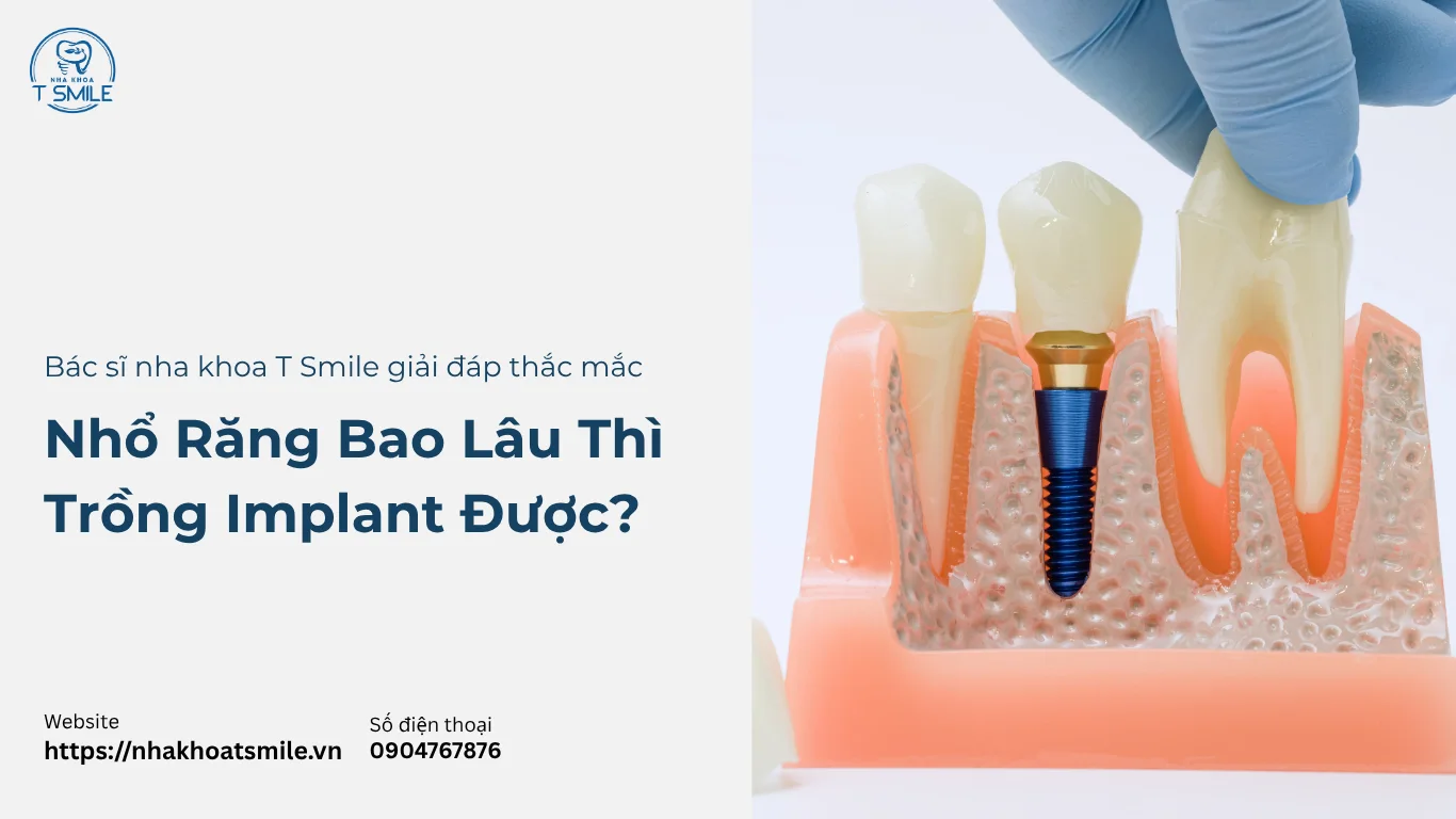 nhổ răng bao lâu thì trồng implant