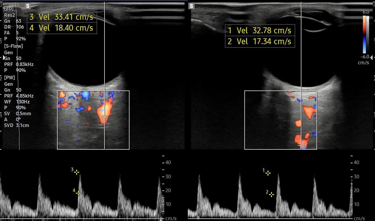 Doppler Động mạch mắt