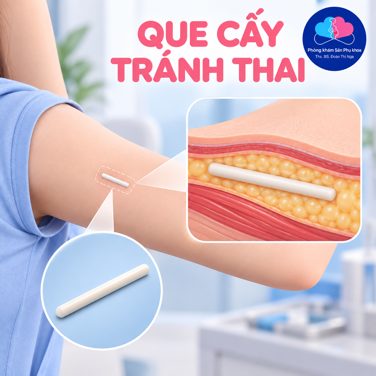 Cấy que tránh thai