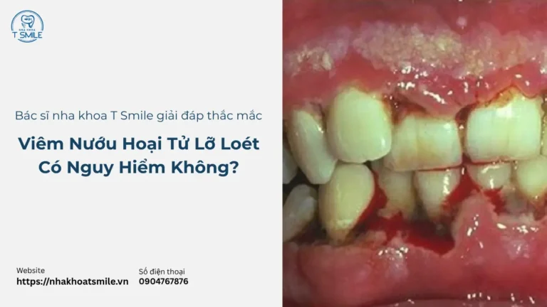 Viêm Nướu Hoại Tử Lở Loét Là Bệnh Gì? Có Nguy Hiểm Không?