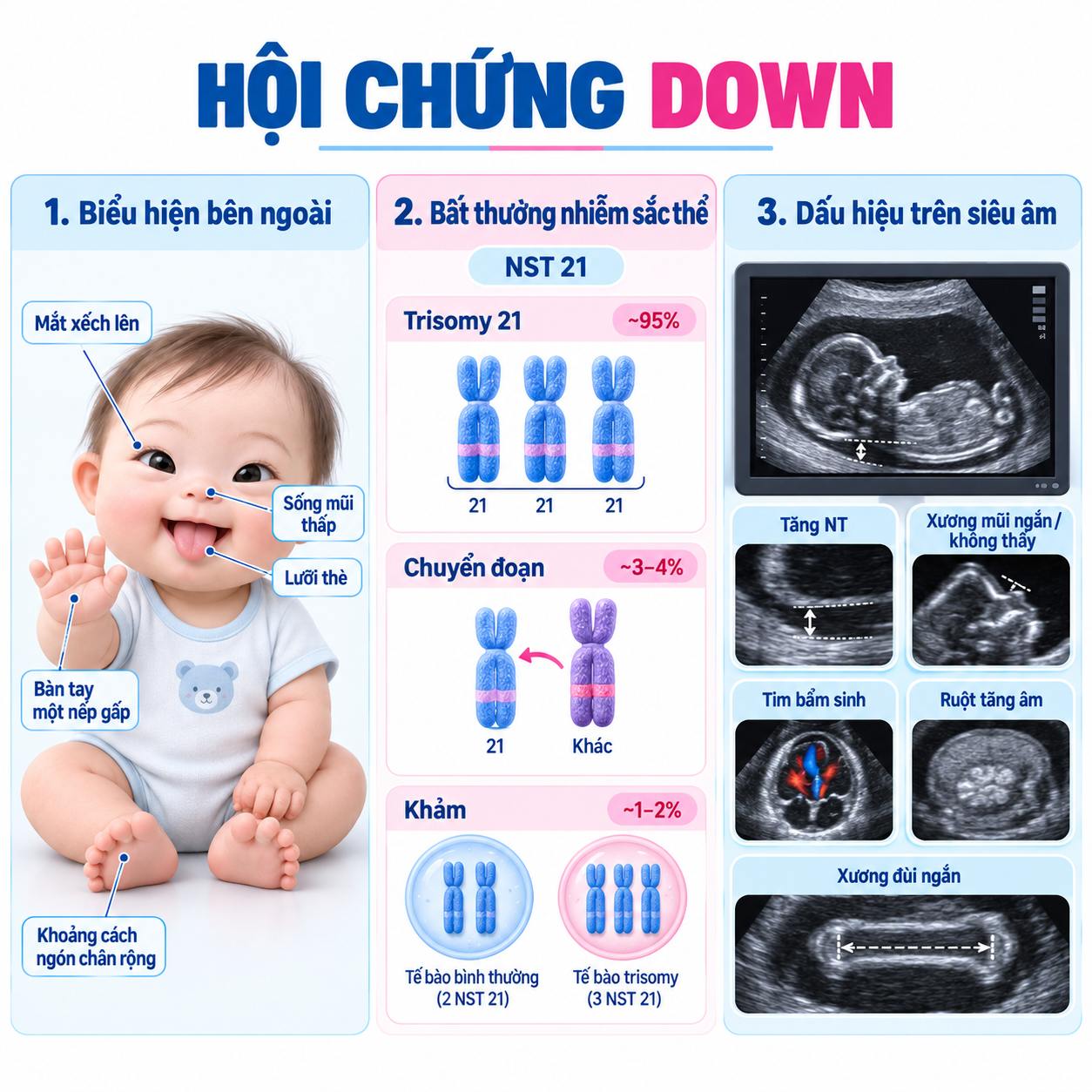 Hội chứng Down